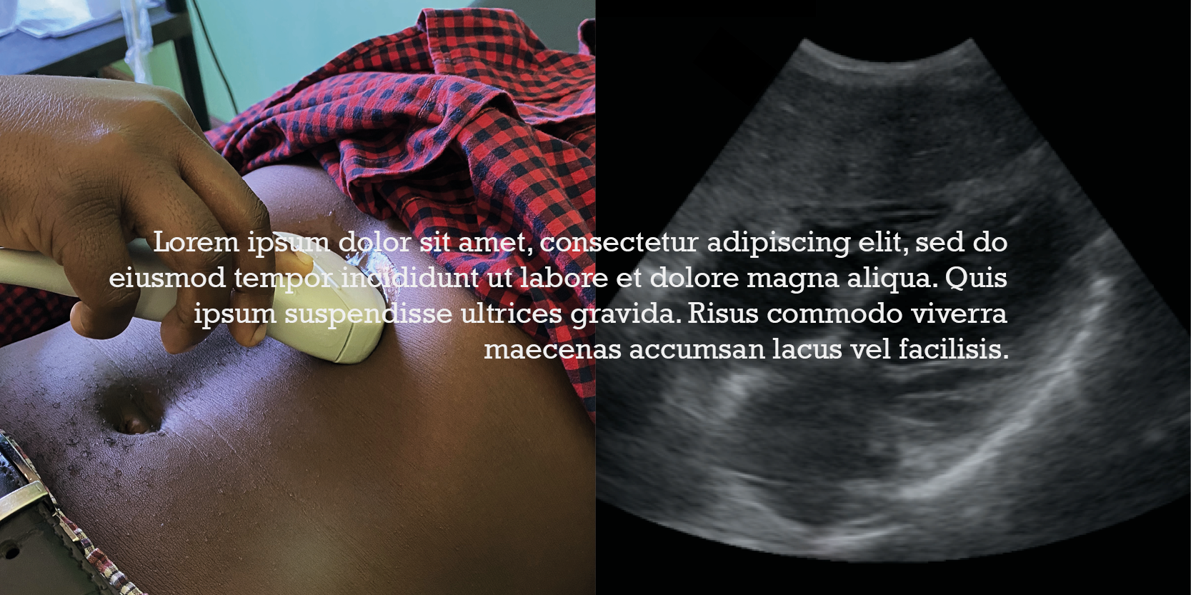 SS2 point of care ultrasound of the lung