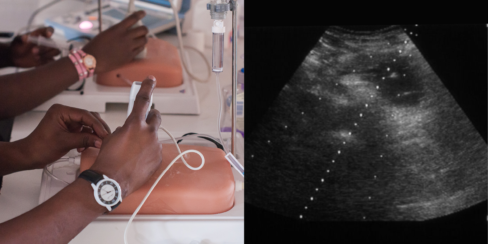 SS4 Interventional Ultrasound - aspiration and biopsy, venous cannulation