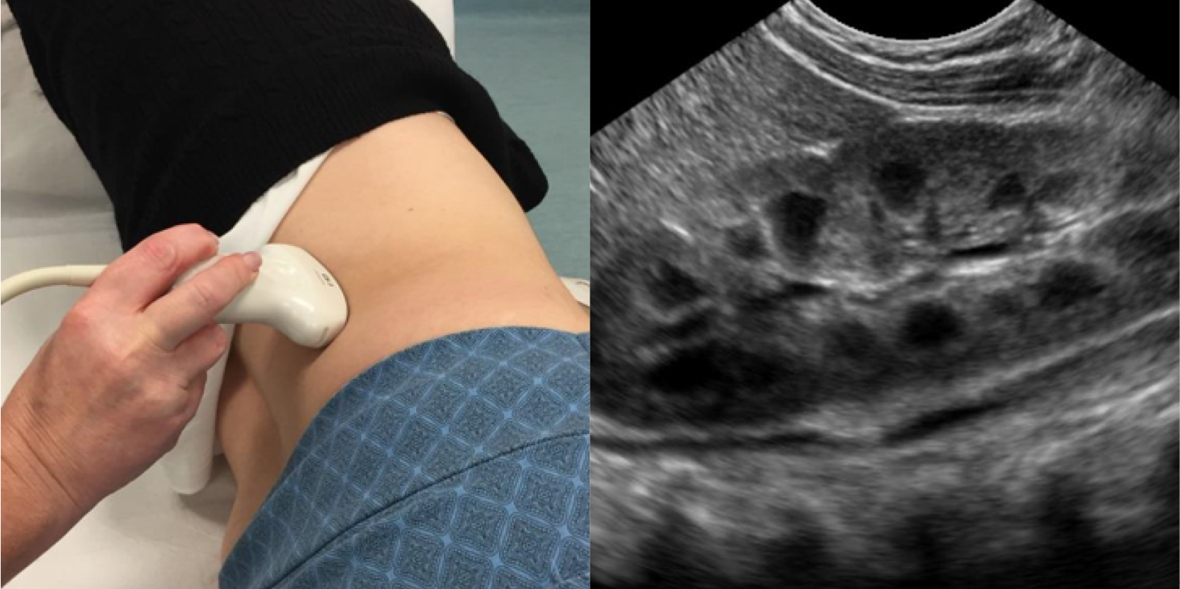 SS6 Ultrasound of the urinary tract