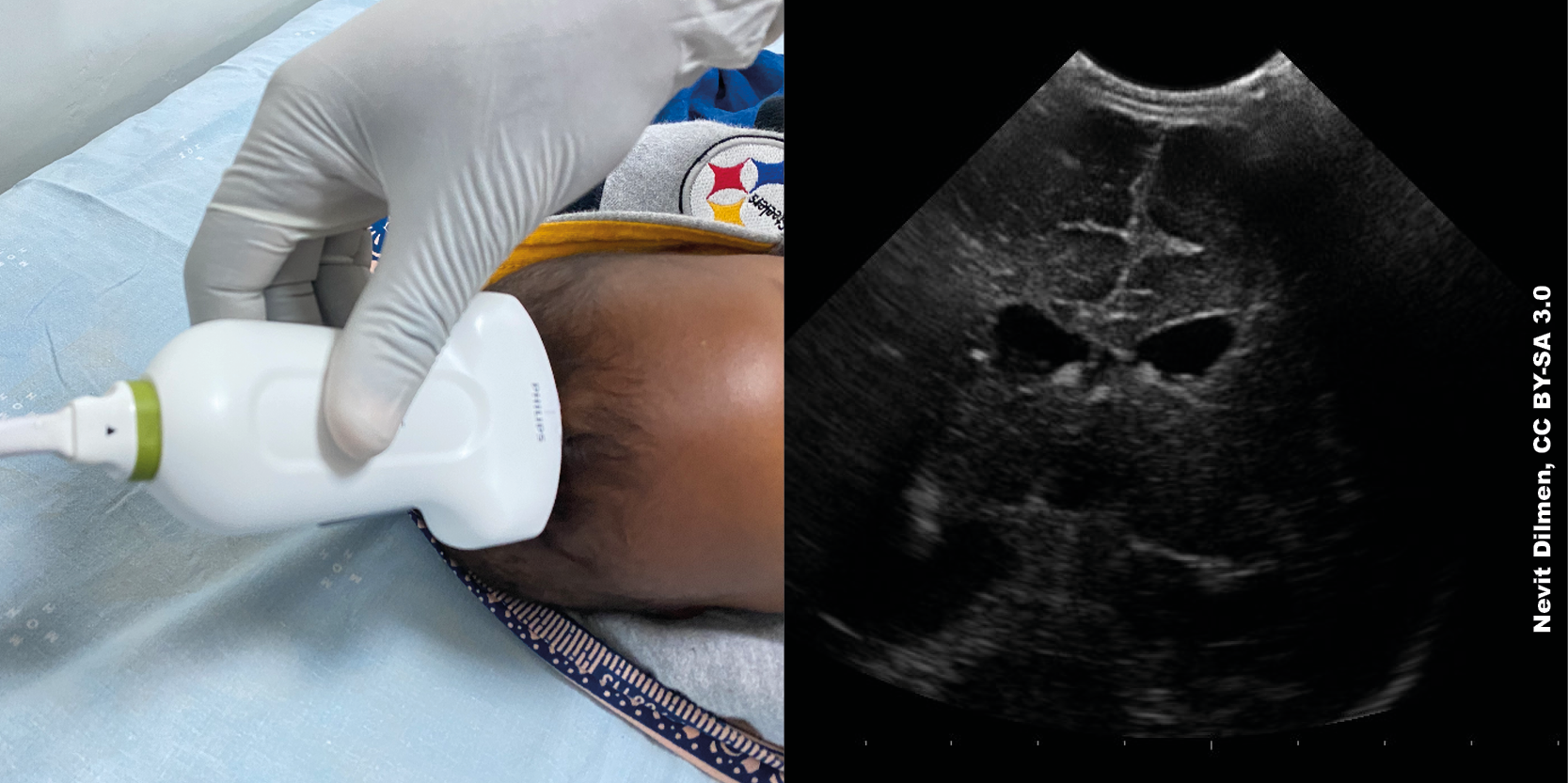 SS8 Ultrasound of the paediatric brain